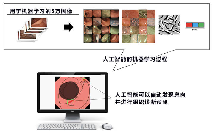 东京慈惠会医科大学利用AI检查大肠息肉等病变